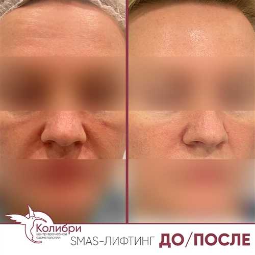 показания и противопоказания для применения смс «лифтинга»