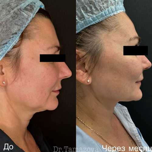 сравнение смс «лифтинга» с другими методами омоложения